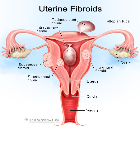 Fibromul uterin - Mami si copilul